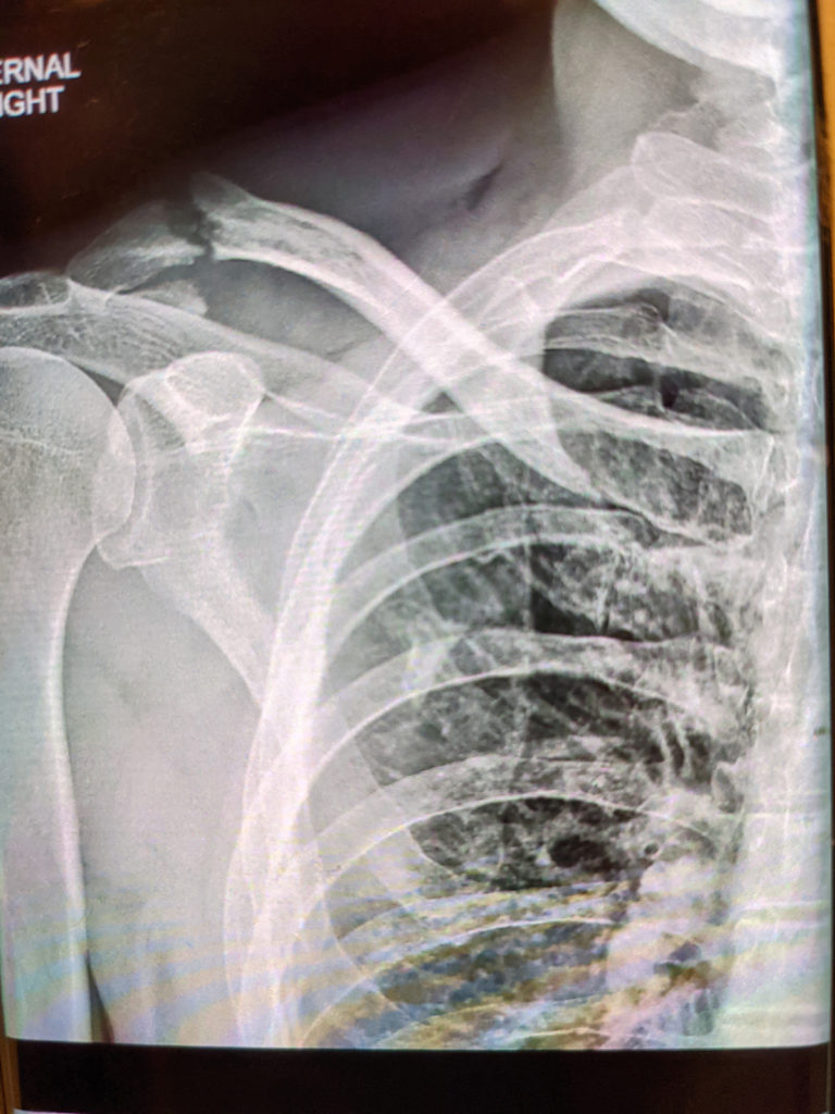 Fractures in Cycling – It’s the Collarbone, Isn’t It?