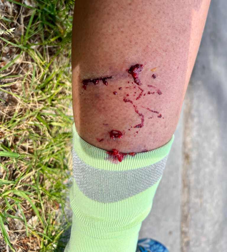 A Dog Attacks You While Cycling, What Do You Do?